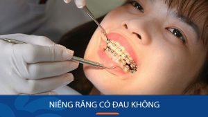 Niềng răng có đau không? 4 Cách giảm khó chịu hiệu quả