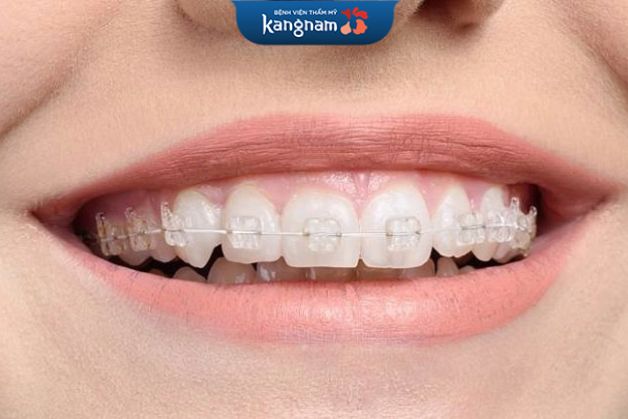 Niềng răng bị khó chịu chỉ trong thời gian ngắn