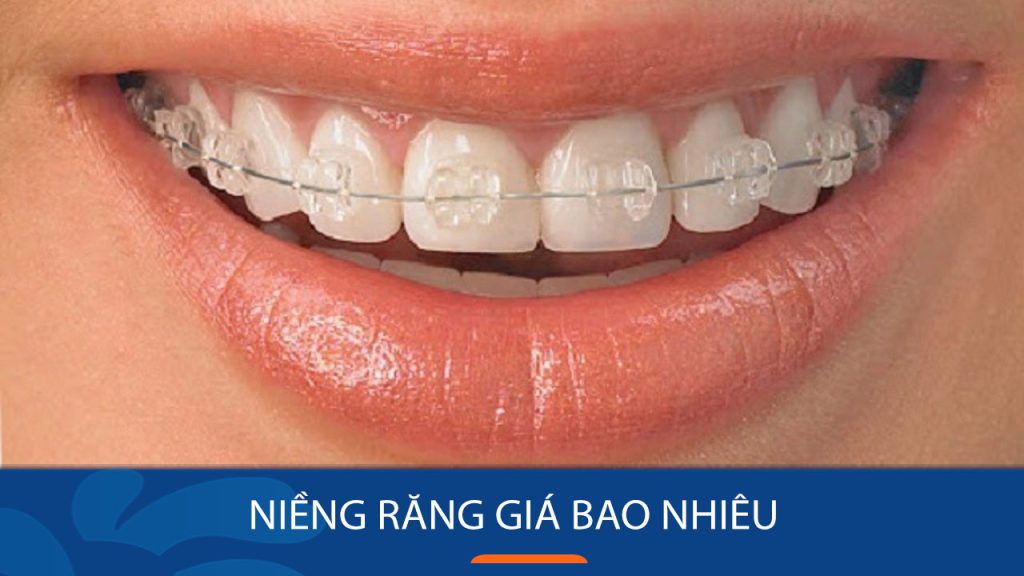 Niềng răng giá bao nhiêu? Các Yếu tố ảnh hưởng đến chi phí