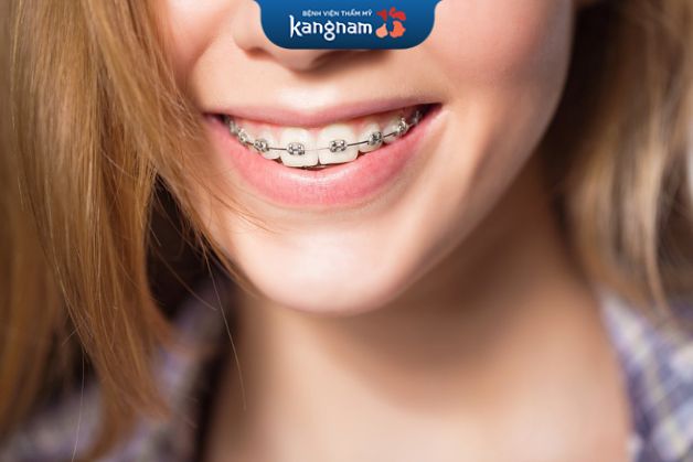Niềng răng là phương pháp sắp xếp cho răng vào đúng vị trí cung hàm