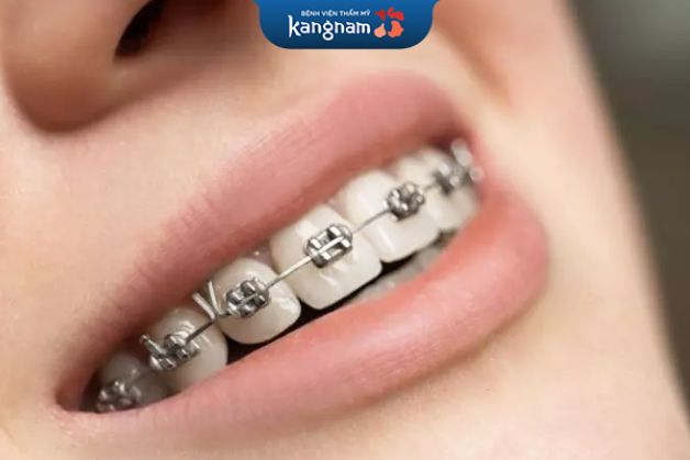 Niềng răng mắc cài kim loại ngày càng phổ biến