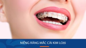 Niềng răng mắc cài kim loại: 7 Điều bạn nên biết