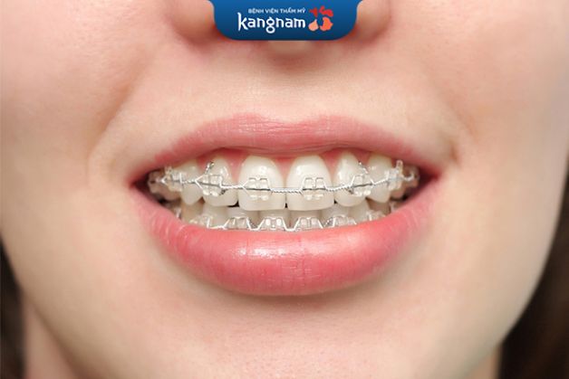 chỉnh nha pha lê được cải tiến từ phương pháp niềng răng bằng mắc cài kim loại