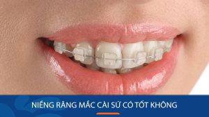 Niềng răng mắc cài sứ có tốt không? Ưu – Nhược điểm là gì?