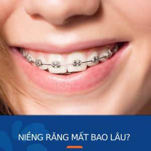 Niềng răng mất bao lâu đối với trẻ em và người lớn?