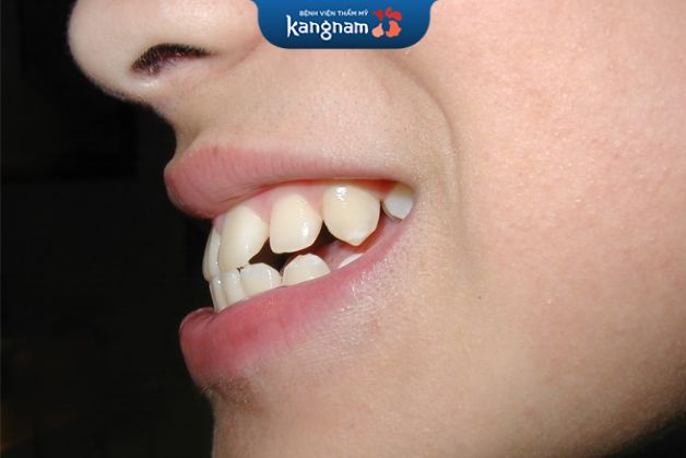 Những trường hợp sai lệch nặng về răng sẽ cần thời gian điều trị lâu hơn