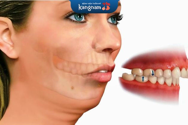 Một vài trường hợp cần áp dụng cả phương pháp phẫu thuật và niềng răng