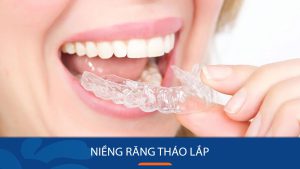 Niềng răng tháo lắp là gì? Có loại nào? Hiệu quả tốt không?