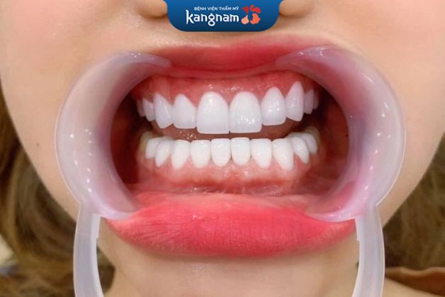 Bọc bằng sứ ngày càng trở thành giải pháp phục hình răng hiệu quả