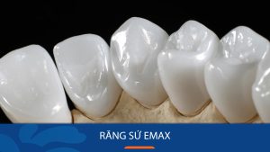 Răng sứ Emax – Răng bọc sứ tự nhiên như thật, bền đẹp