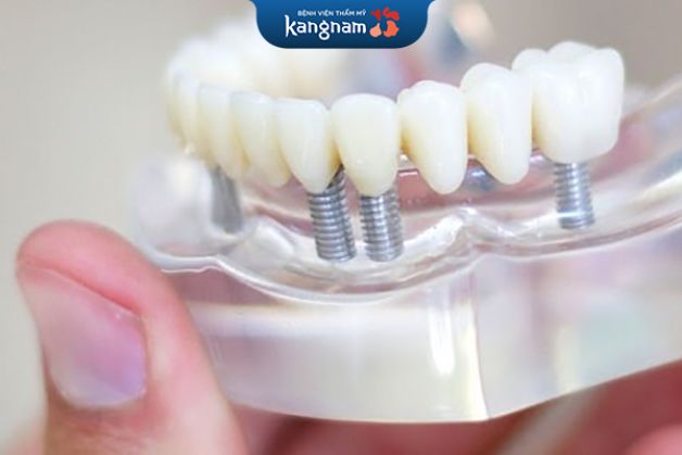 Tuổi thọ của răng Emax có thể kéo dài từ 15-20 năm
