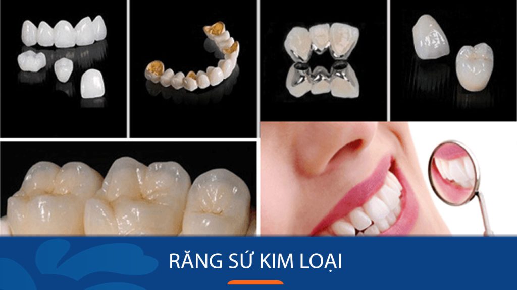 Răng sứ kim loại có tốt không? Duy trì được bao lâu?