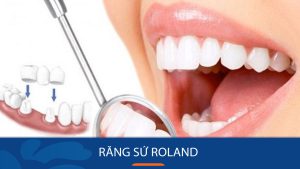 Răng sứ Roland: 5 Điều bạn nhất định phải biết