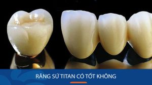 Răng sứ Titan có tốt không? Giá bọc sứ Titan bao nhiêu tiền