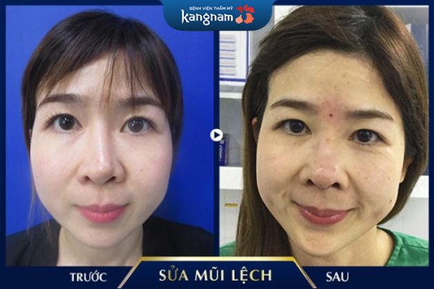 Sửa dáng mũi vẹo thành công cho khách hàng tại Kangnam