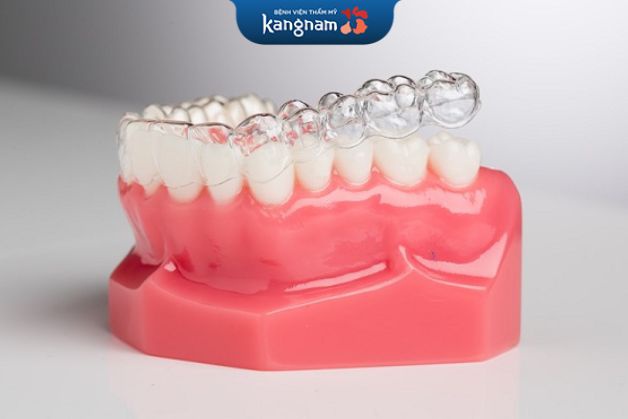 Niềng răng với khay trong suốt là công nghệ cao nên cần đảm bảo sử dụng chất liệu cao cấp