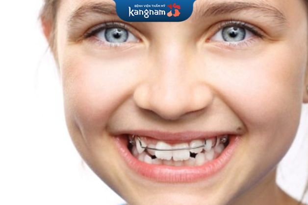 Trẻ từ 8-10 tuổi niềng răng cần từ 6 tháng đến 1 năm