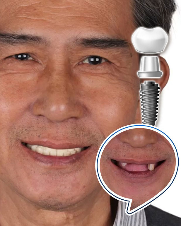 Trồng răng mới bằng trụ Implant