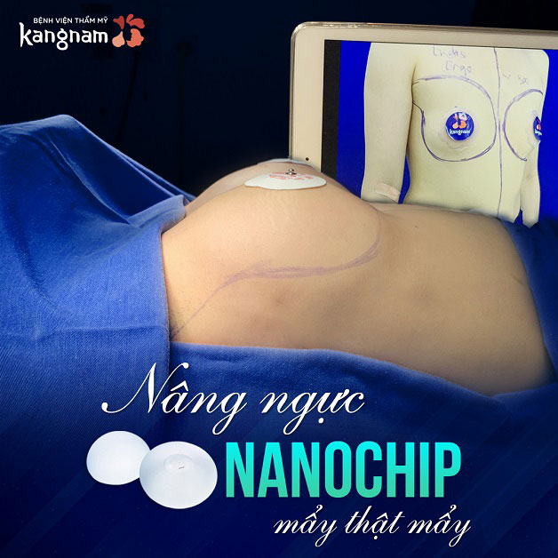 Nâng ngực Nanochip mẩy thật mẩy