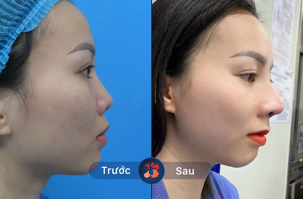 Trước và sau khi khách hàng nâng mũi 