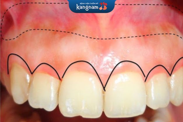 Cắt lợi có can thiệp xương ổ răng cần từ 3-6 tháng để lành thương