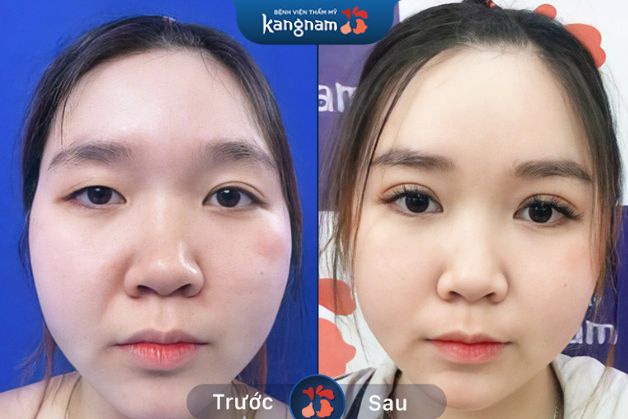Cắt mí Plasma Plus cải thiện nhan sắc, thay đổi tướng mạo đẹp hơn