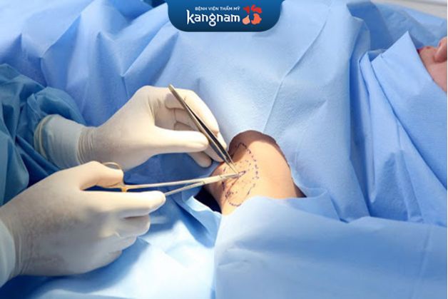 Kangnam thực hiện cắt tuyến mồ hôi nách an toàn, hiệu quả