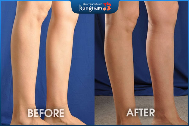 Cấy mỡ bắp chân không gây đau nhức, kết quả tự nhiên đẹp hoàn hảo