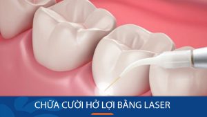 Công nghệ chữa cười hở lợi bằng laser: lưu ý quan trọng