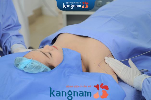 Cắt tuyến mồ hôi nách hiệu quả tại Kangnam