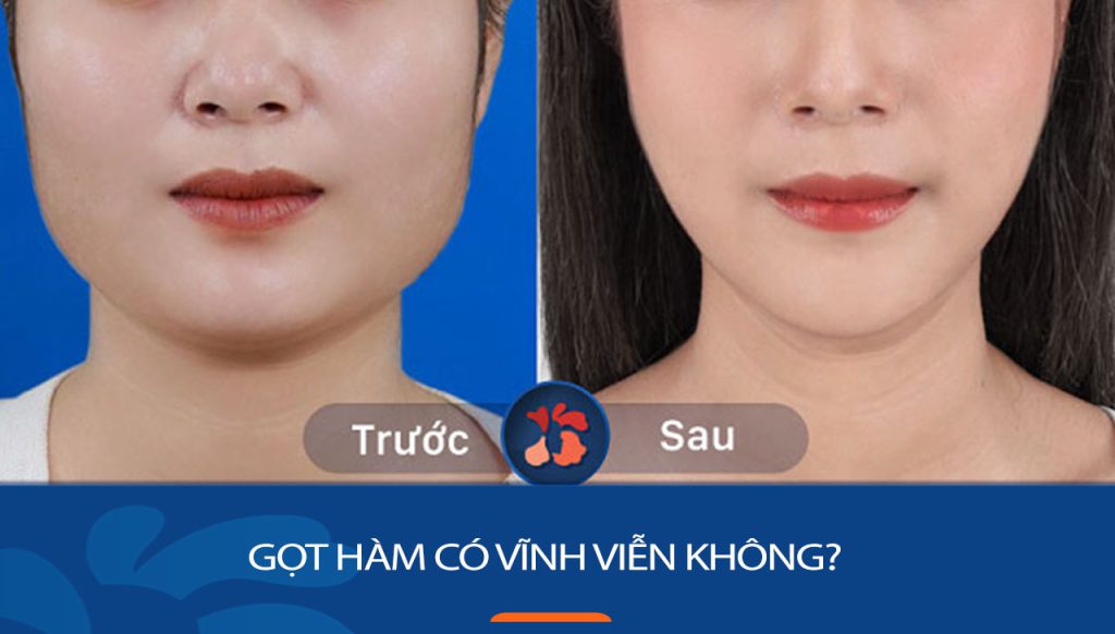 Gọt hàm có vĩnh viễn không? Hiệu quả và độ bền lâu dài như thế nào?