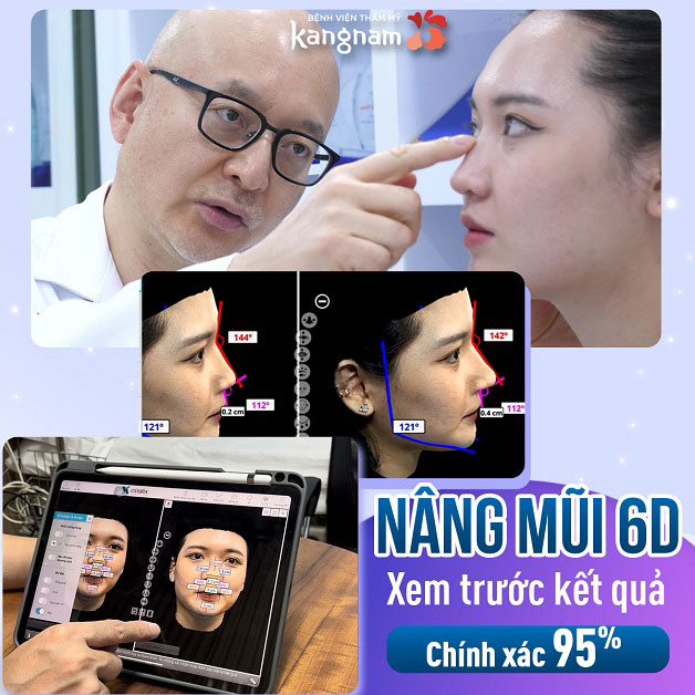 Kangnam có áp dụng công nghệ xem trước kết quả nâng mũi Vectra 3D hiện đại