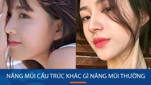 Nâng mũi cấu trúc khác gì nâng mũi thường? Chia sẻ từ chuyên gia