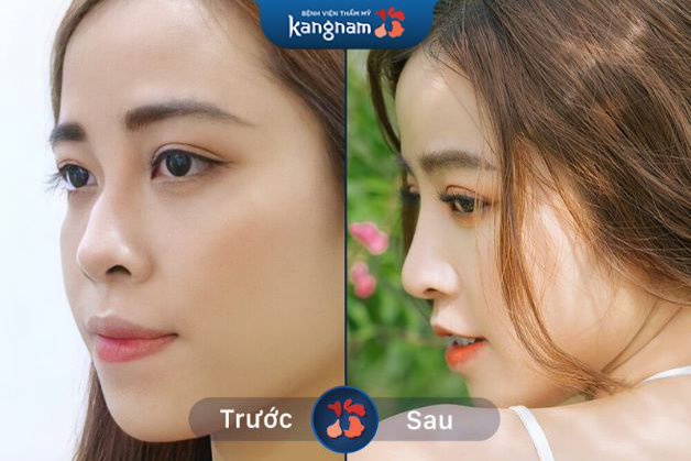Khách hàng nâng mũi chuẩn đẹp, không méo lệch