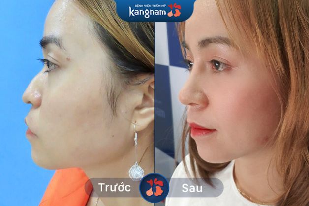 Cải thiện dáng mũi thấp tẹt hiệu quả