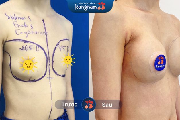 Nâng ngực tại Kangnam, khách hàng nhanh chóng hồi phục chỉ sau 7-10 ngày
