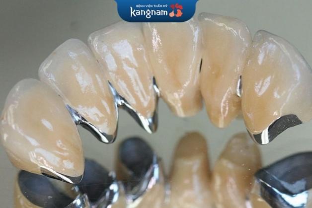 Răng sứ titan có một vài điểm hạn chế