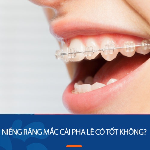 Niềng răng mắc cài pha lê có tốt không? Ưu Nhược điểm