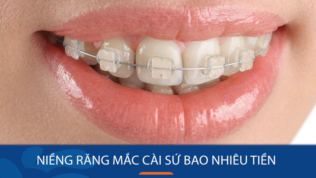 Niềng răng mắc cài sứ bao nhiêu tiền? Ưu điểm khi niềng