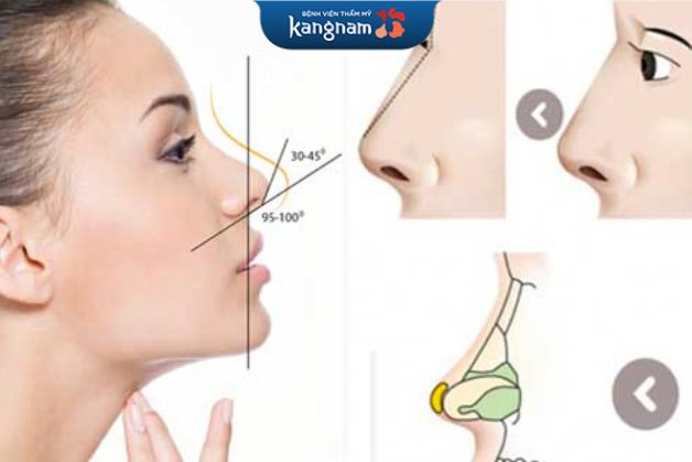 Phẫu thuật nâng xương chính mũi giúp chỉnh hình mũi thẳng