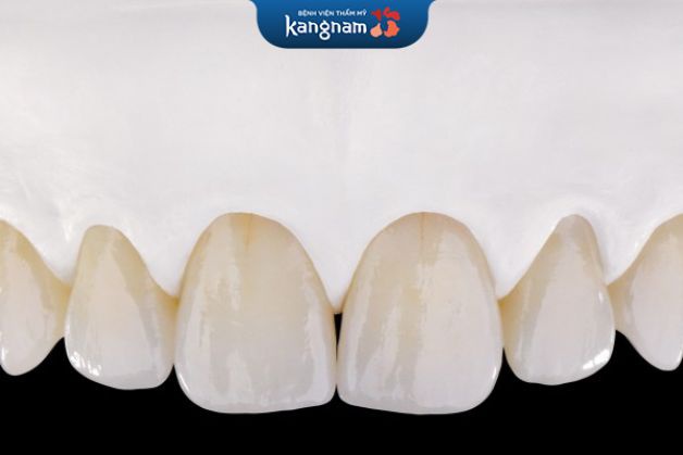 răng sứ kim loại có tuổi thọ kéo dài từ 5 - 7 năm