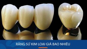 Răng sứ kim loại giá bao nhiêu? Trả góp được không?