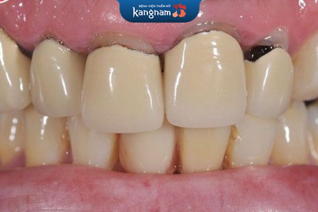 Răng sứ kim loại thường có tuổi thọ khá thấp