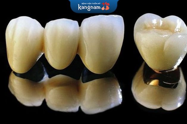 Răng kim loại titan có thể duy trì 5-7 năm nếu chăm sóc tốt