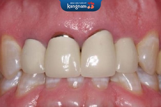 Răng sứ titan thường được bảo hành 5 năm tại các đơn vị nha khoa