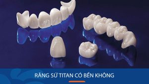 Răng sứ titan có bền không? Bật mí cách chăm sóc tốt