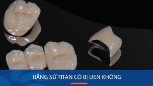 Răng sứ titan có bị đen không? 3 Dòng sứ không đen