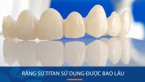 Răng sứ titan sử dụng được bao lâu? Cách tăng tuổi thọ răng sứ