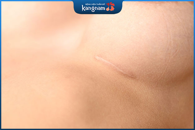 Sẹo sau nâng ngực phụ thuộc vào vị trí nâng ngực