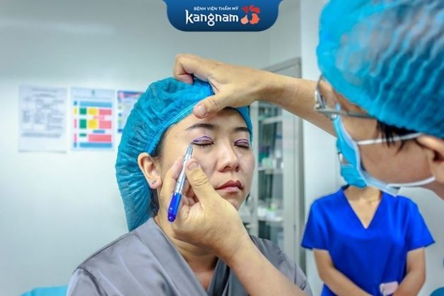 tay nghề bác sĩ nguyên nhân khiến cắt mí mắt bị thâm 